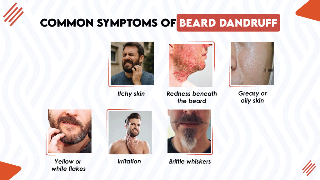 What is Beard Dandruff