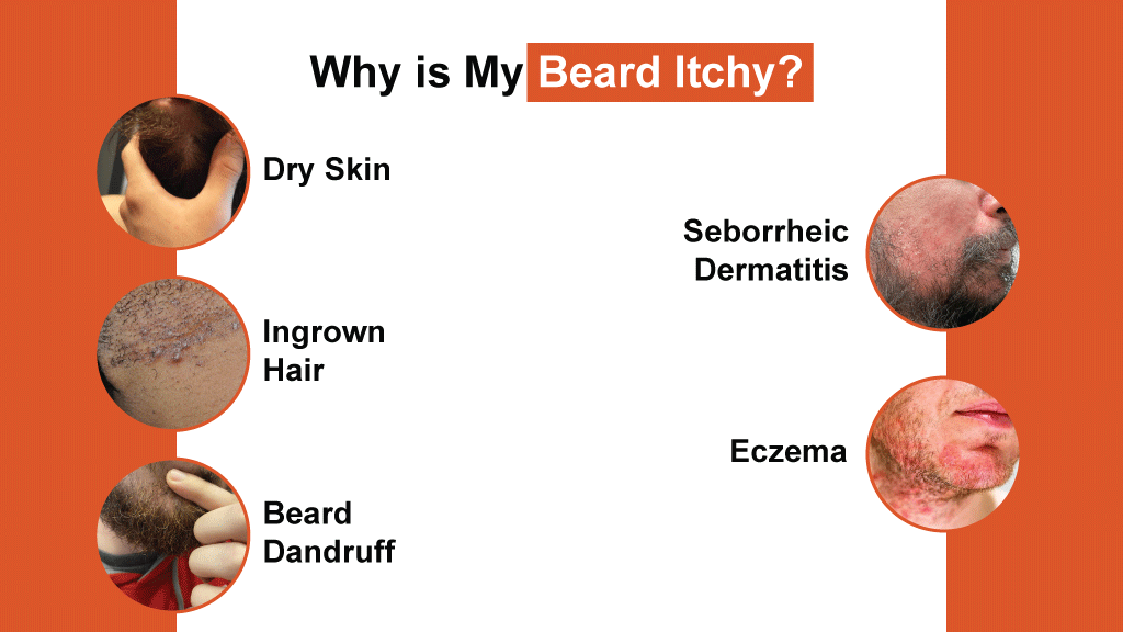 Why is My Beard Itchy
