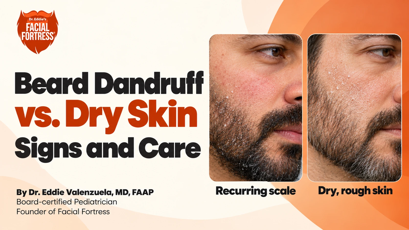 Beard dandruff versus dry skin: side-by-side close-ups illustrate recurring scale and dry, rough skin; signs and care.