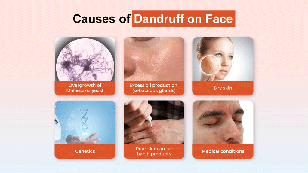 Facial dandruff including yeast overgrowth, oily skin, dryness, genetics, harsh skincare products, and medical conditions.