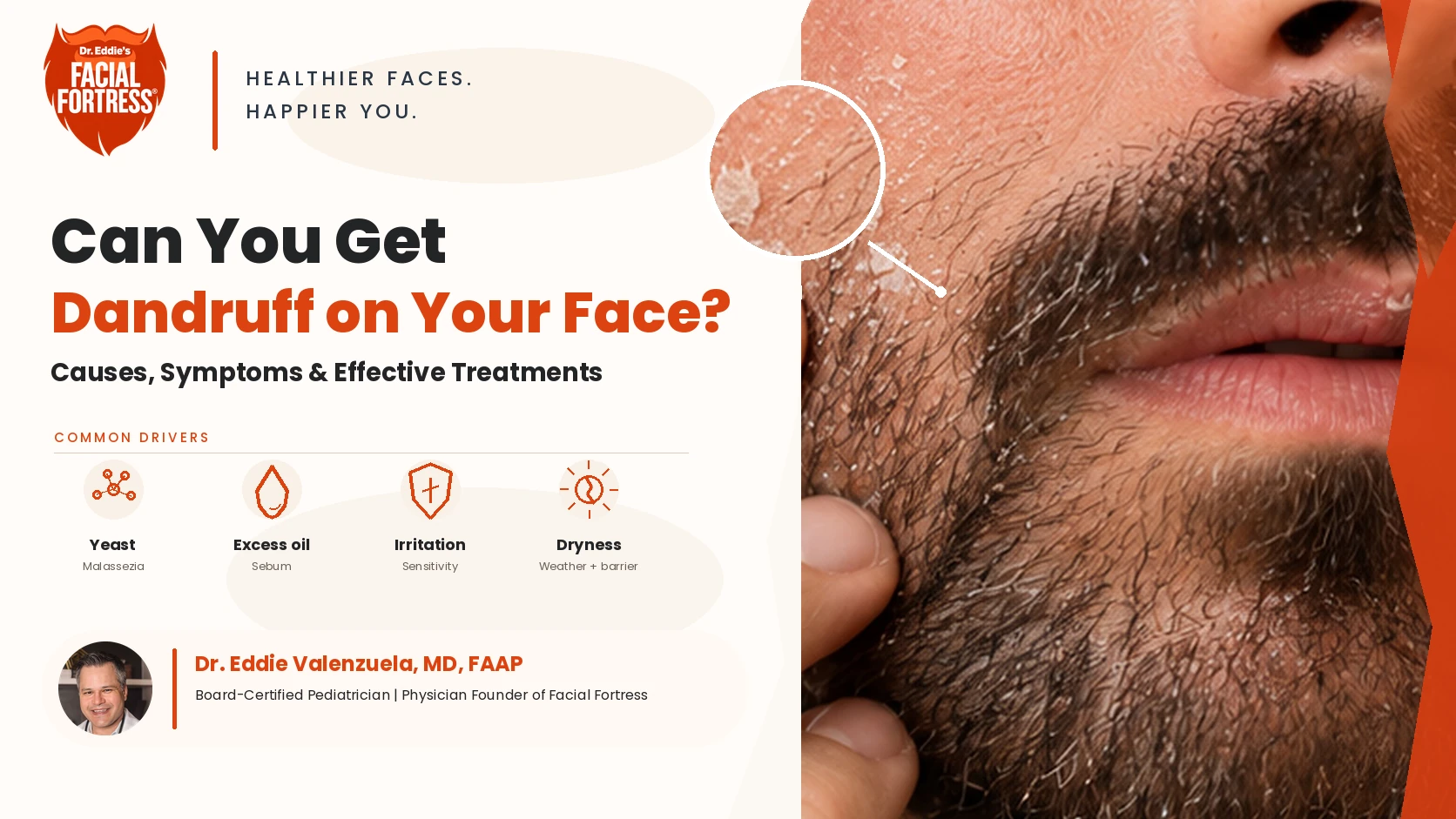 Man with visible facial dandruff around the eyebrows, nose, and beard area illustrating causes, symptoms, and treatments, Facial Fortress