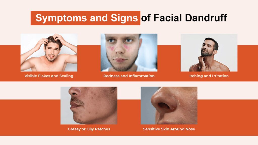 facial dandruff including visible flakes, redness, itching, oily patches, and sensitive skin around the nose.