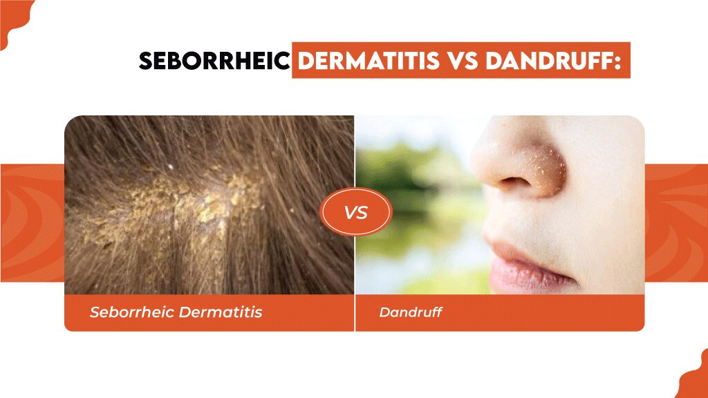 How do you know if you have seborrheic dermatitis or dandruff? Dandruff and seborrheic dermatitis may be caused by the same yeast and look quite similar; however, there are a few differences between them.