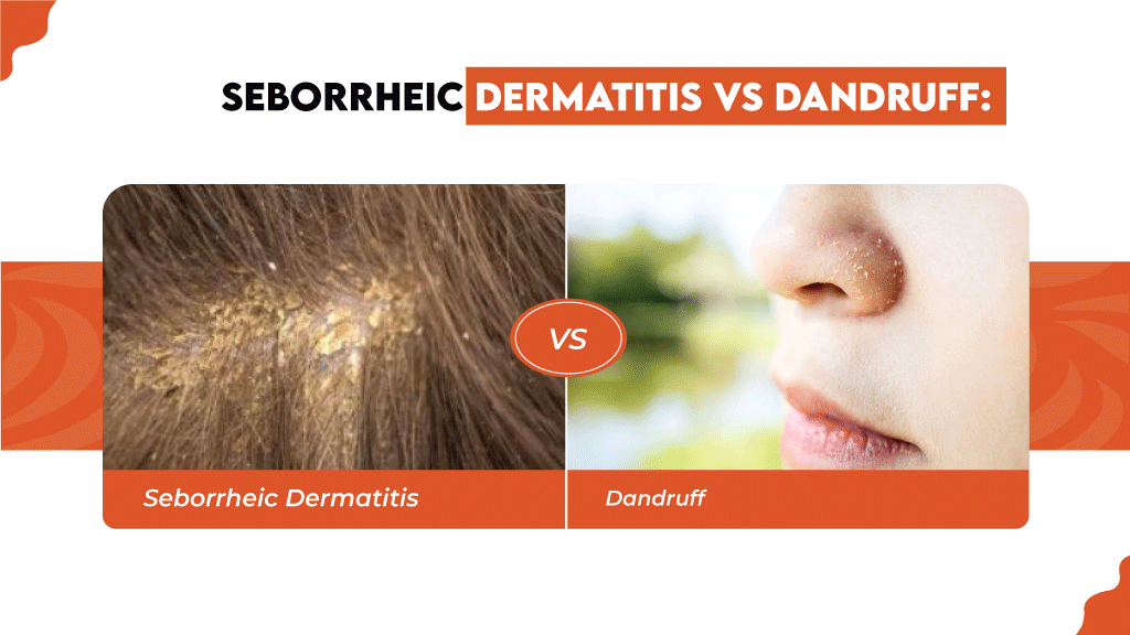 How do you know if you have seborrheic dermatitis or dandruff? Dandruff and seborrheic dermatitis may be caused by the same yeast and look quite similar; however, there are a few differences between them.