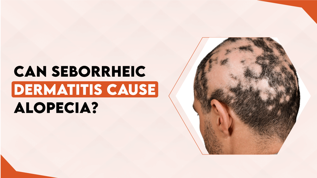 Can Seborrheic Dermatitis Cause Alopecia?