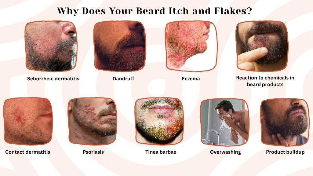 Why Does Your Beard Itch and Flakes?