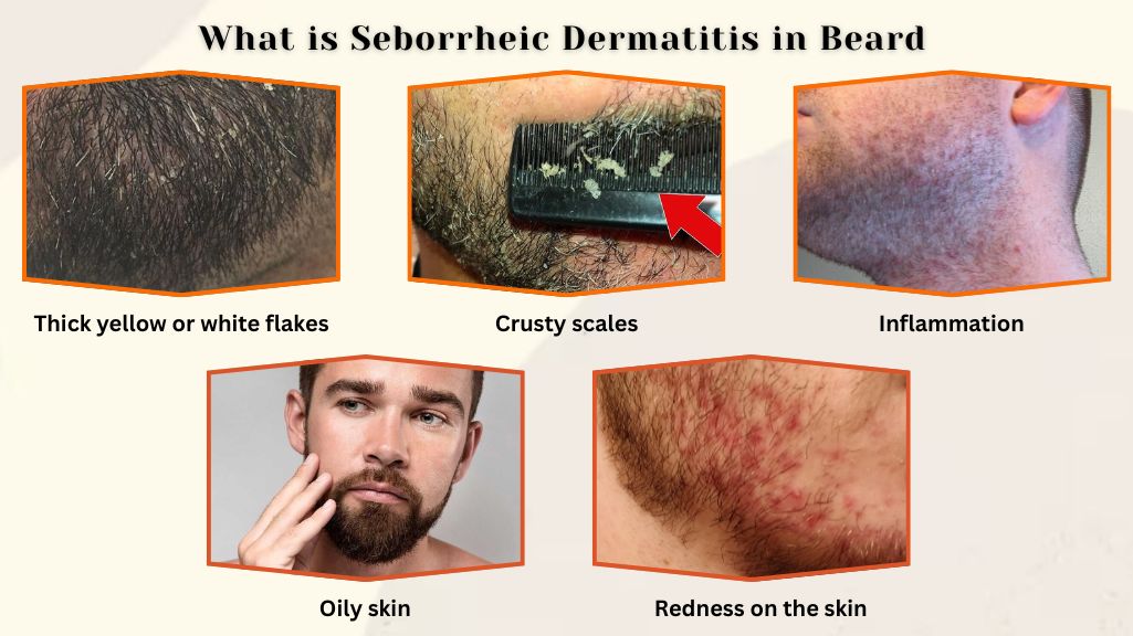 Seborrheic Dermatitis in Beard