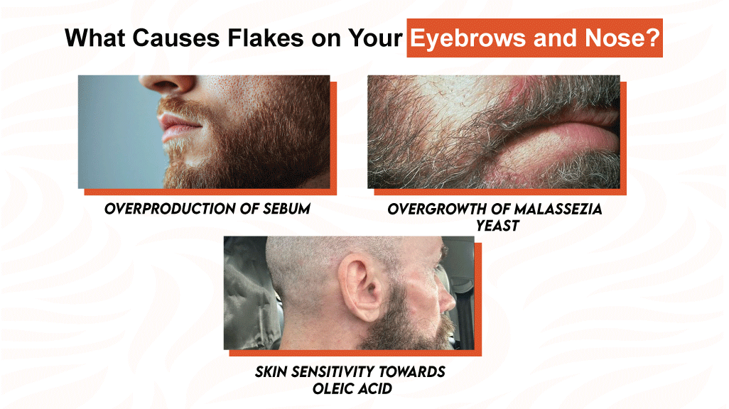 What Causes Flakes on Your Eyebrows and Nose?