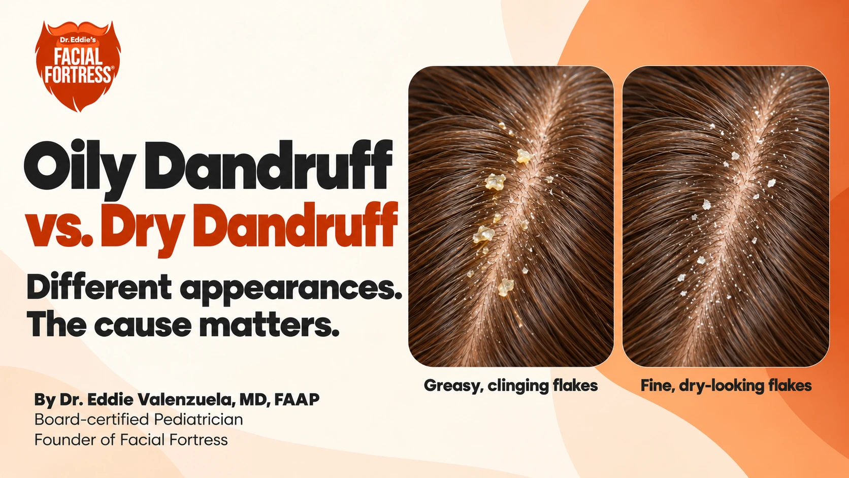 Oily dandruff vs. dry dandruff: side-by-side scalp images comparing greasy, clinging flakes with fine, dry-looking flakes.