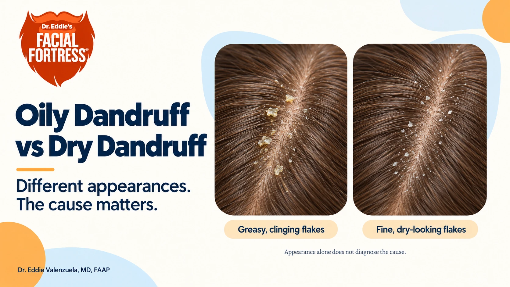 Illustrated comparison of greasy, clinging scalp flakes and fine, dry-looking flakes.