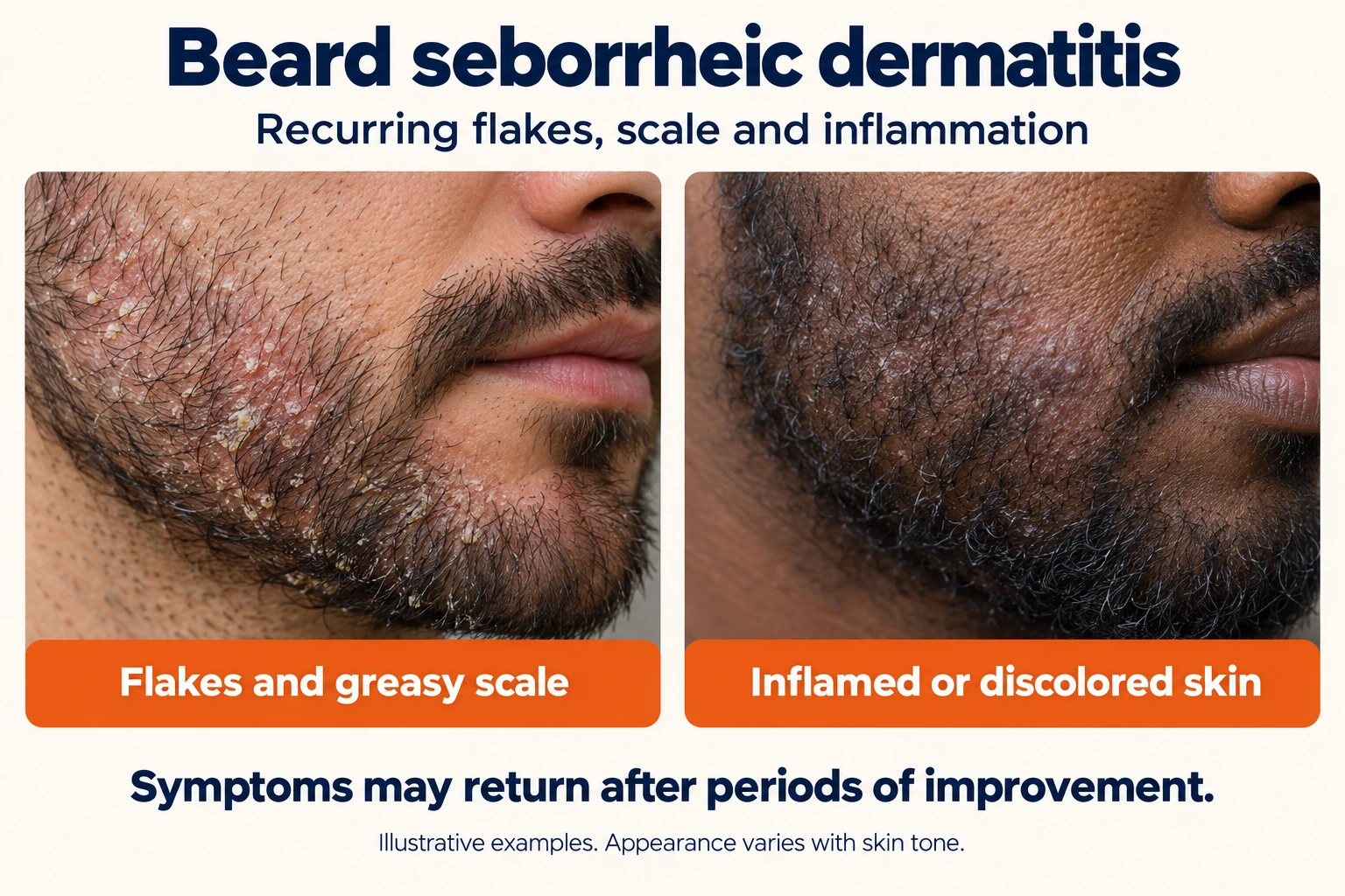 Medical illustrations of beard seborrheic dermatitis with flakes, scale and skin discoloration across skin tones.