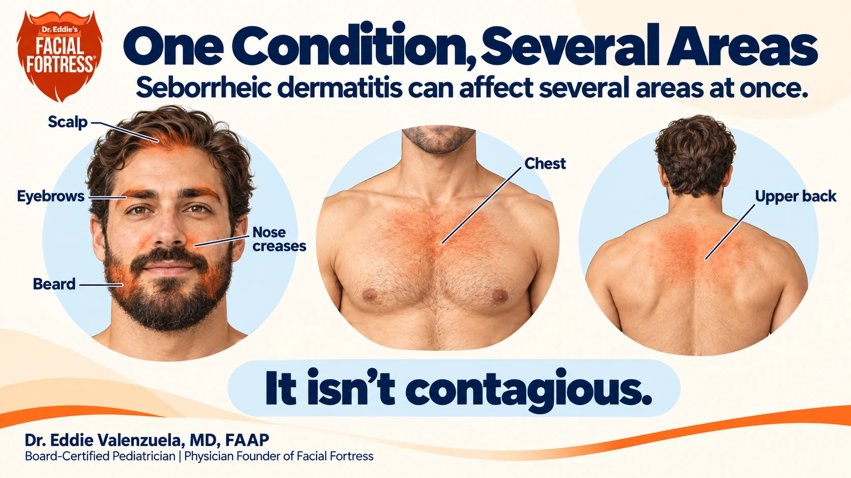 Seborrheic dermatitis locations: scalp, eyebrows, nose creases, beard, chest, and upper back. The condition is not contagious.