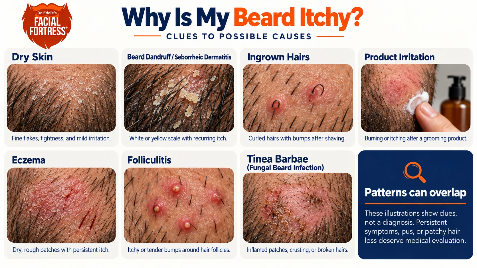 Illustrated beard-itch clues: dry skin, seborrheic dermatitis, ingrown hairs, product irritation, eczema, folliculitis, and tinea barbae.