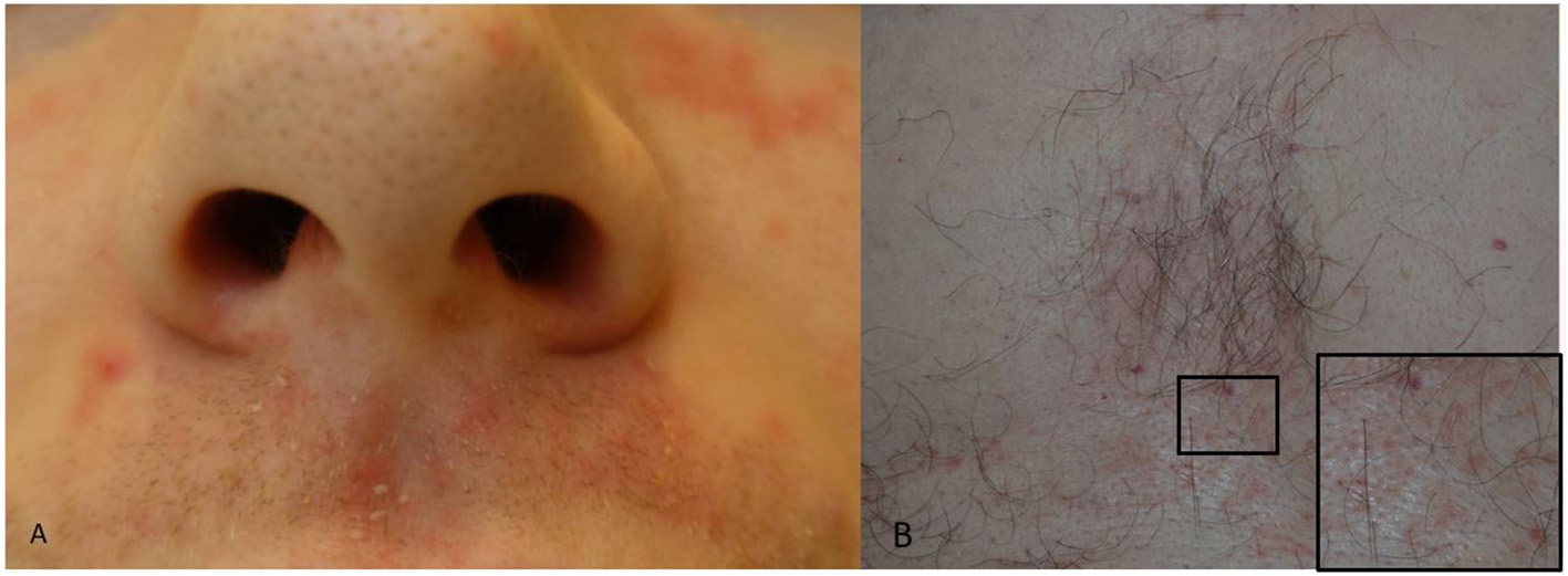 Clinical photographs of seborrheic dermatitis beside the nose and upper lip in panel A and on the chest in panel B.